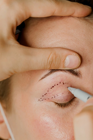 Blepharoplasty Mumbai